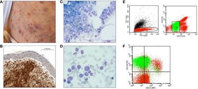 Frontiers Real World Evidence On Tagraxofusp For Blastic Plasmacytoid